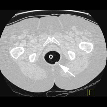 virtual colon: Large polyp (11mm) rectum - CTisus CT Scan