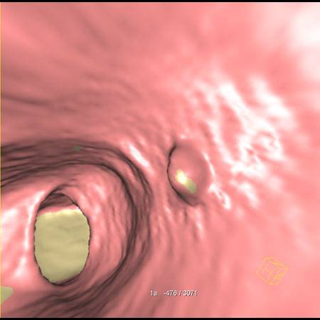 virtual colon: Small, 8mm polyp descending colon. - CTisus CT Scan