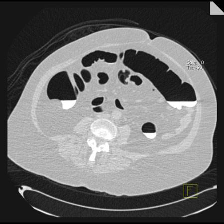 virtual colon: Large, 10mm flat polyp on fold in ascending colon - CTisus CT Scan