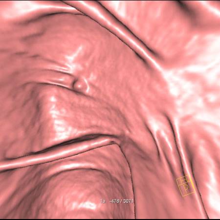 virtual colon: Small, 8mm polyp right colon near level of valve - CTisus CT Scan
