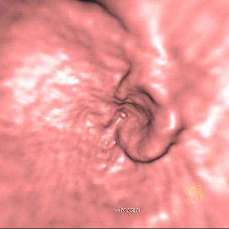 virtual colon: Rectal cancer obscured by rectal tube/balloon. - CTisus CT Scan
