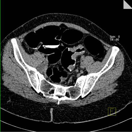 virtual colon: Sigmoid cancer and multiple polyps - CTisus CT Scan
