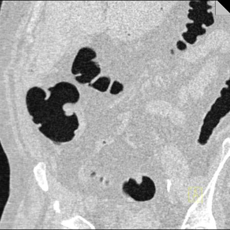 virtual colon: Normal exam with normal ileocecal valve - CTisus CT Scan