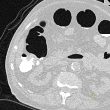 virtual colon: Colon cancer near hepatic flexure - CTisus CT Scan