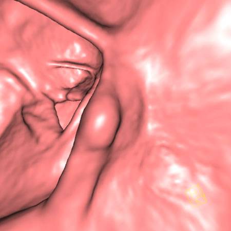 virtual colon: 1.2 cm lipoma on fold in ascending colon - CTisus CT Scan