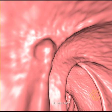 virtual colon: Small 8mm polyp rectum with adjacent stool tagging - CTisus CT Scan
