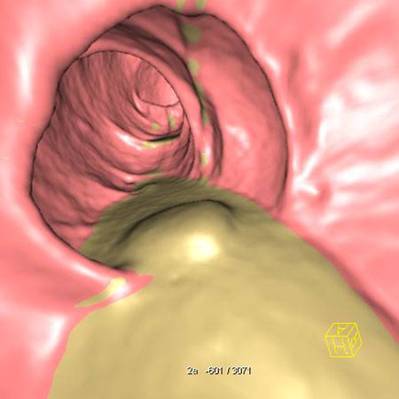 virtual colon: Residual stool (probably pill) and mucous strands. - CTisus CT Scan