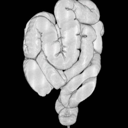 virtual colon: Normal - CTisus CT Scan