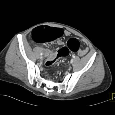 virtual colon: Large 4 cm cecal   adenocarcinoma with extension/fistula into sigmoid and uterus - CTisus CT Scan