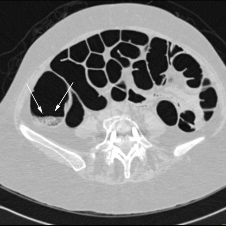 virtual colon: Untagged stool. - CTisus CT Scan