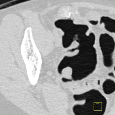 virtual colon: Large 2 cm polyp cecum. - CTisus CT Scan