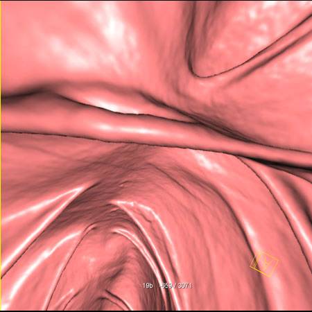 virtual colon: Adherent poorly tagged mobile stool near valve on supine only. - CTisus CT Scan