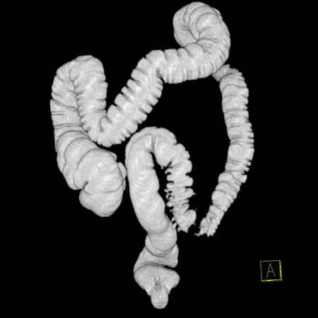 virtual colon: 4.5 cm apple core cancer sigmoid. - CTisus CT Scan