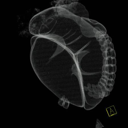 virtual colon: Sigmoid volvulus. - CTisus CT Scan