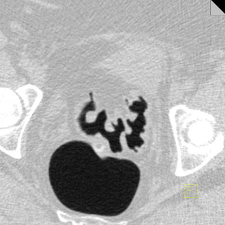 virtual colon: Diverticulosis and circular muscle hypertrophy sigmoid. - CTisus CT Scan