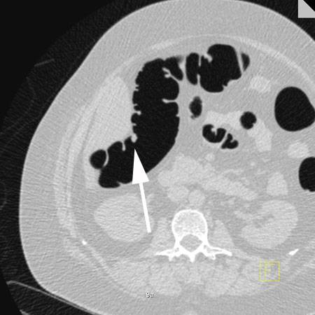 virtual colon: Small 6 mm polyp ascending colon - CTisus CT Scan