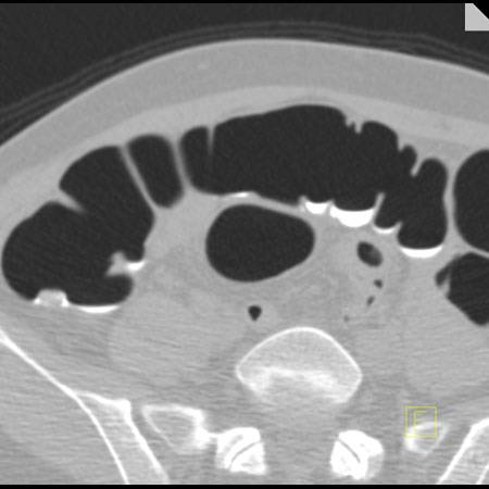 virtual colon: Mobile stool ascending colon. - CTisus CT Scan
