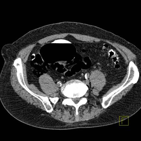 virtual colon: Perforation right colon with extraluminal air. Divertilucosis. - CTisus CT Scan