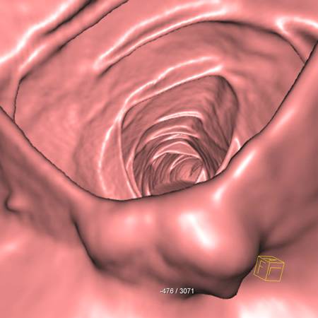 virtual colon: Normal ileocecal valve. - CTisus CT Scan