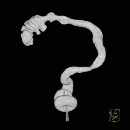 virtual colon: Ulcerative colitis with featureless and shortened colon. - CTisus CT Scan