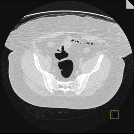 virtual colon: Cancer sigmoid colon. Unable to distend segment of sigmoid on any view. - CTisus CT Scan