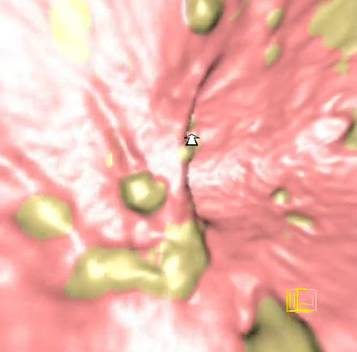 virtual colon: Small 9mm polyp cecum. Significant residual stool colon. - CTisus CT Scan