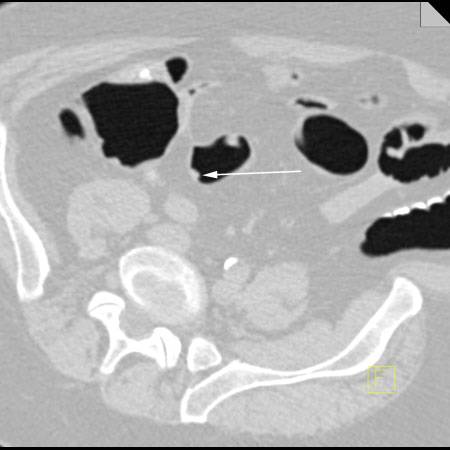 virtual colon: Small 8mm polyp sigmoid. - CTisus CT Scan