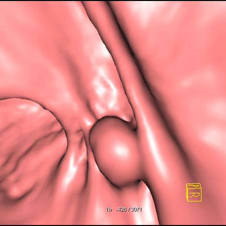 virtual colon: Large 1.1 cm polyp ascending colon, diminutive 5mm polyp cecum (seen only on prone) - CTisus CT Scan