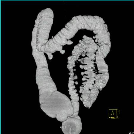 virtual colon: Extensive diverticulosis sigmoid colon. - CTisus CT Scan