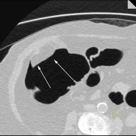 virtual colon: 3.5 cm lipoma ascending colon - CTisus CT Scan