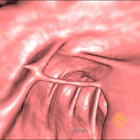 virtual colon: Mucous strand ascending colon. - CTisus CT Scan