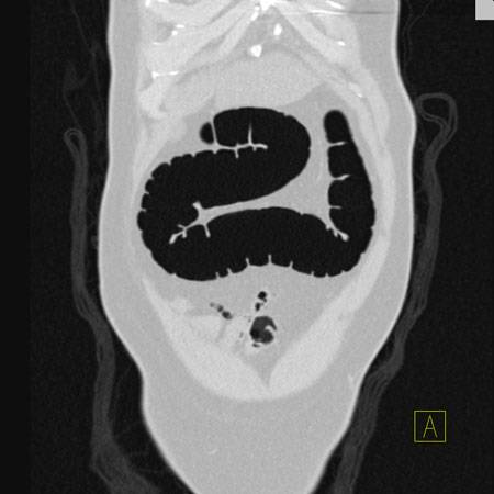virtual colon: Normal. - CTisus CT Scan