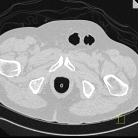 virtual colon: Left inguinal hernia containing colon. - CTisus CT Scan