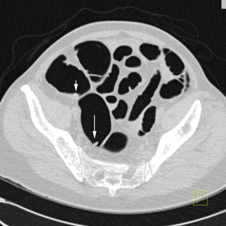 virtual colon: Multiple polyps (polyposis coli). - CTisus CT Scan