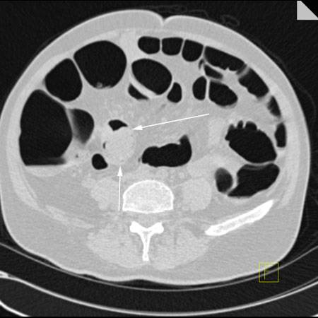 virtual colon: Large 4 cm tubulovillous adenoma sigmoid in a patient with polyposis coli. - CTisus CT Scan