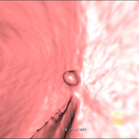 virtual colon: Small 7mm polyp splenic flexure. - CTisus CT Scan