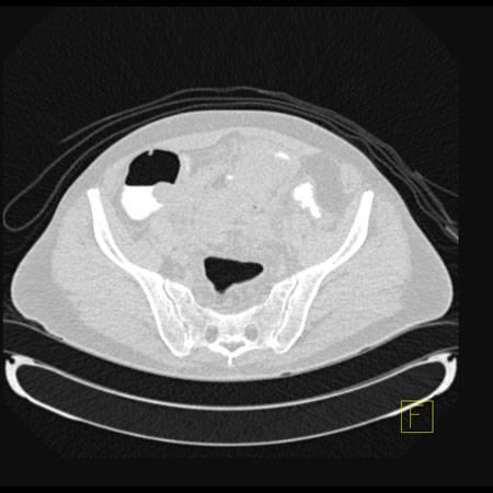 virtual colon: Large 2 cm polyp at tip of cecum. - CTisus CT Scan