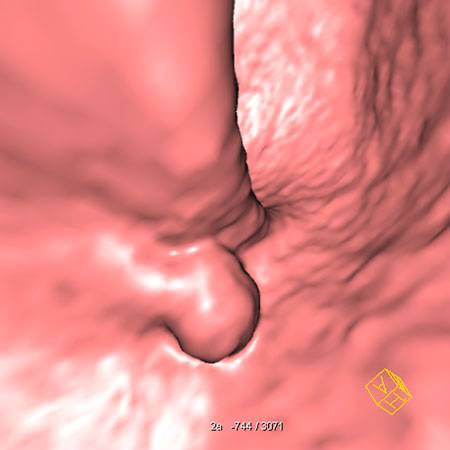 virtual colon: Large 1 cm polyp rectum. - CTisus CT Scan