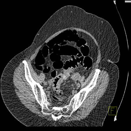 virtual colon: Severe diverticular disease sigmoid preventing adequate distention. - CTisus CT Scan