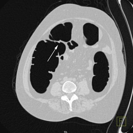 virtual colon: Small 6 mm polyp cecum. - CTisus CT Scan