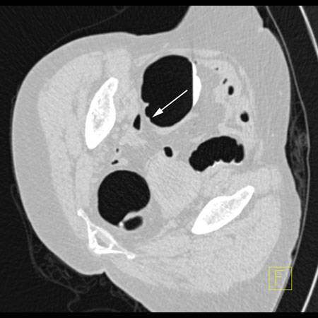 virtual colon: No polyp. Adherent corn kernel cecum - CTisus CT Scan
