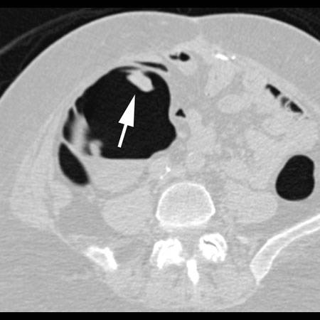 virtual colon: Large 2 cm polyp cecum. - CTisus CT Scan