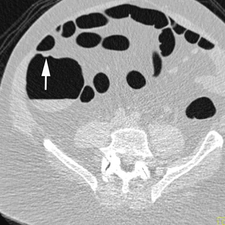 virtual colon: Large 1 cm polyp cecum. - CTisus CT Scan
