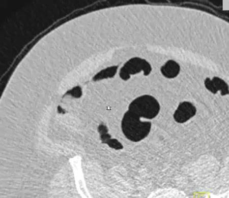 virtual colon: Large 1.2 cm polyp ascending colon - CTisus CT Scan