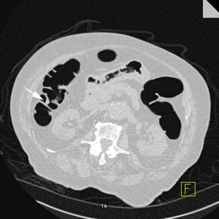 virtual colon: Small 7mm polyp ascending colon.  Patient had multiple small polyps throughout the colon. Also there is residual untagged stool. - CTisus CT Scan