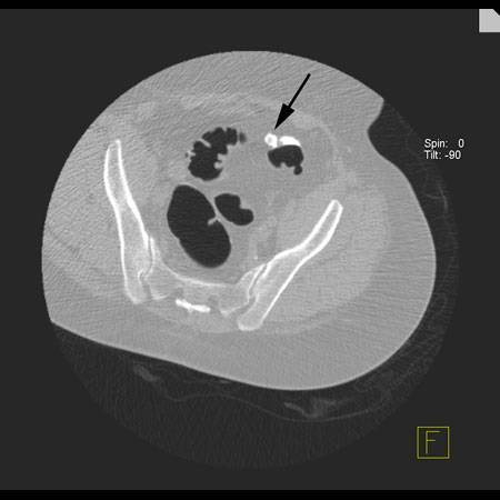 virtual colon: Stool impacted in diverticulum. - CTisus CT Scan