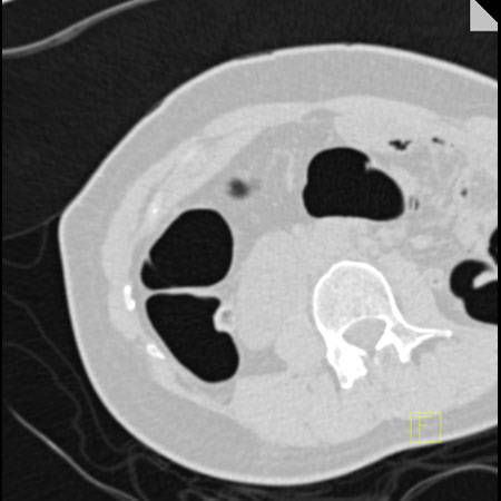 virtual colon: Stool impacted in diverticulum. - CTisus CT Scan