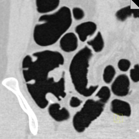 virtual colon: Inverted appendiceal stump. - CTisus CT Scan