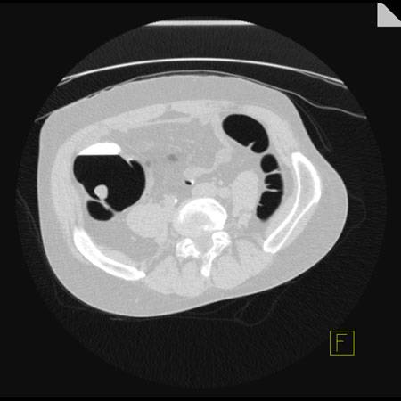 virtual colon: Large 1.6 cm polyp cecum near ileocecal valve. - CTisus CT Scan