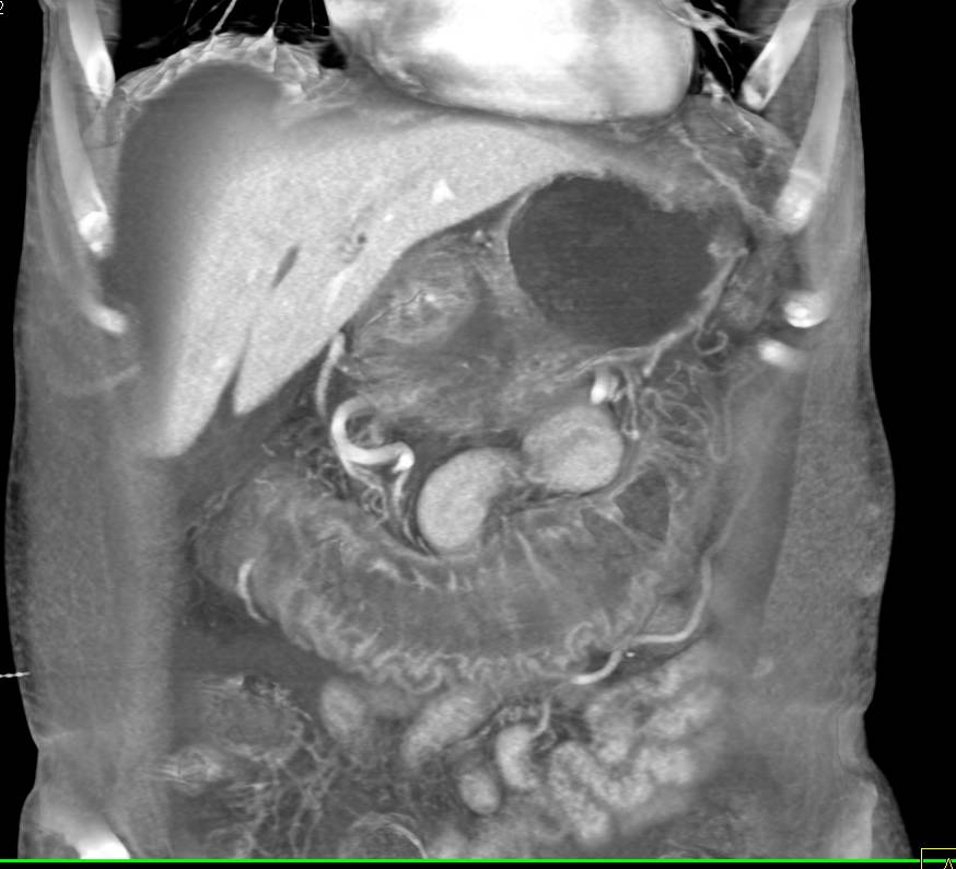 Pseudomembranous Colitis with Ascites - CTisus CT Scan